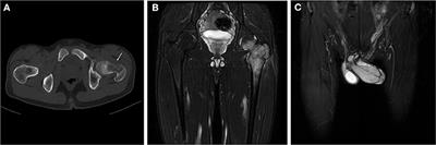 Case Report: Primary Ewing Sarcoma of the Penis With Multiple Metastases
